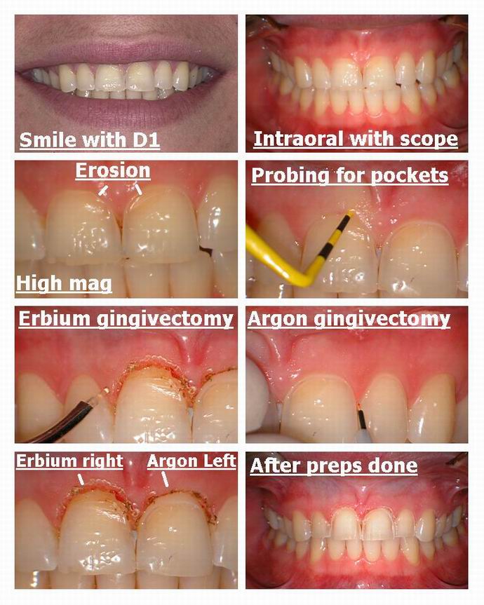 Resize of Veneers and lasers Act 1.jpg